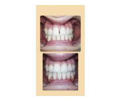 3 SHAPE-EXOCAD TASARIMCI