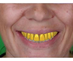 Dijital dental design desteği verilir